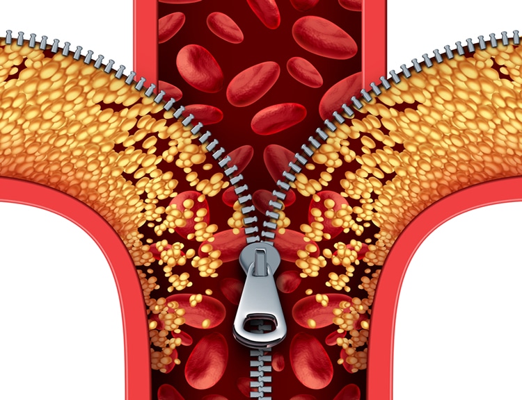 Cholesterol bloedbaan